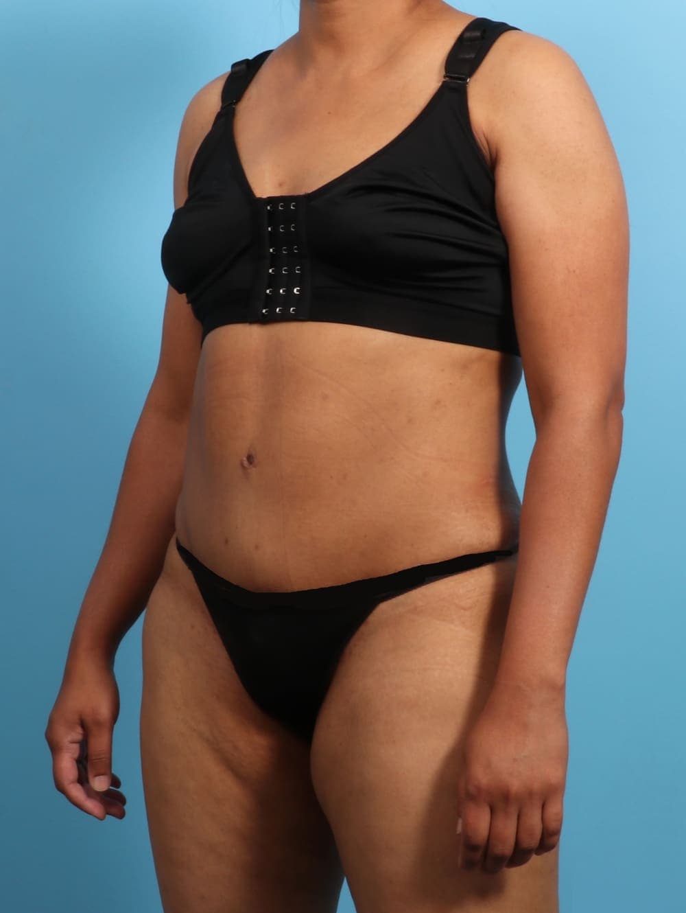 Liposuction case #2711 after, image 2