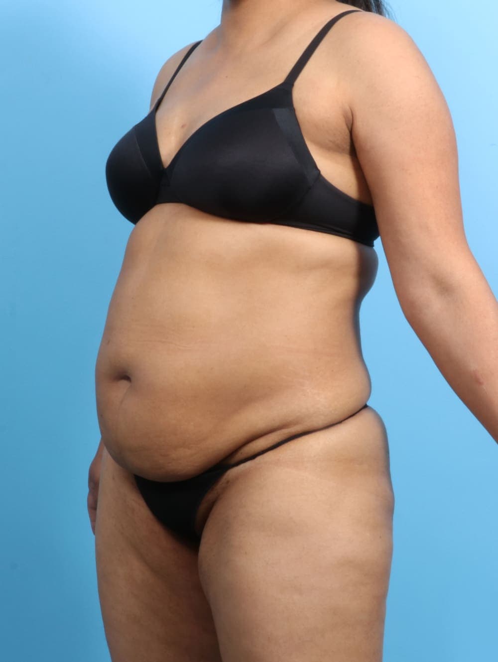 Liposuction case #2711 before, image 2
