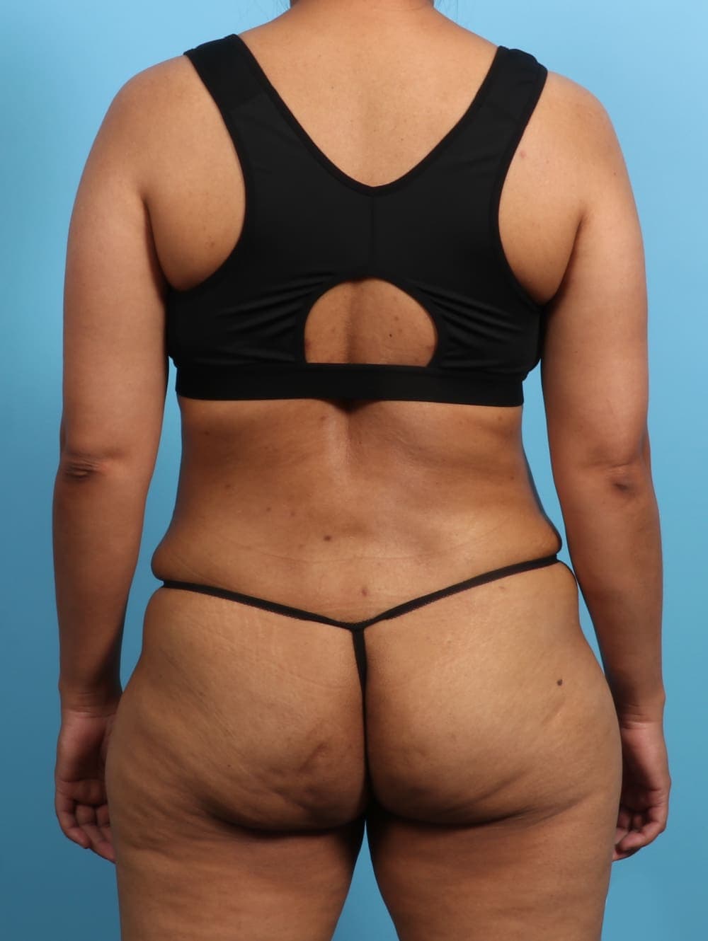 Liposuction case #2711 after, image 4