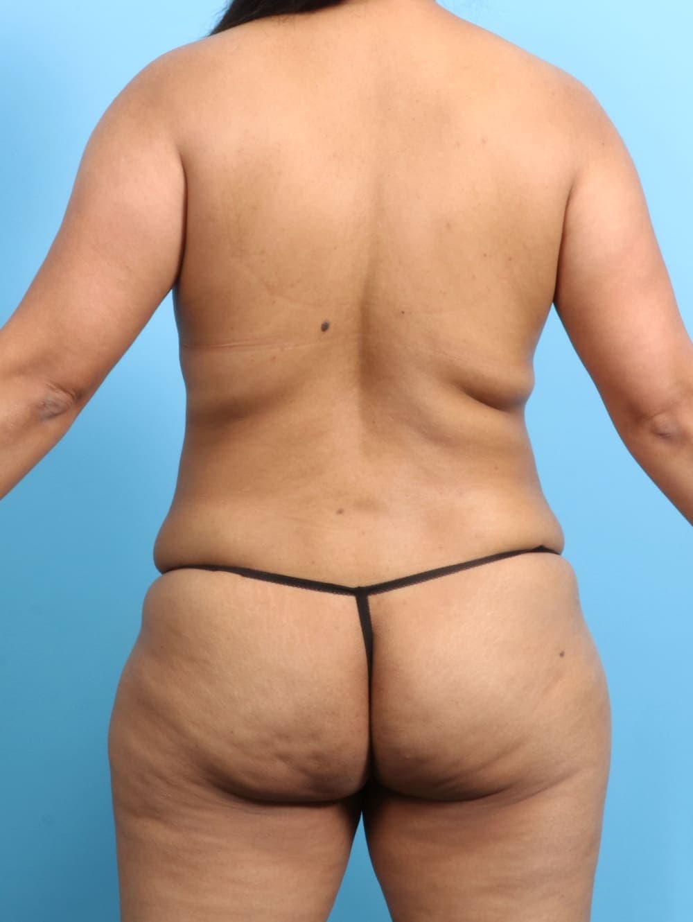 Liposuction case #2711 before, image 4