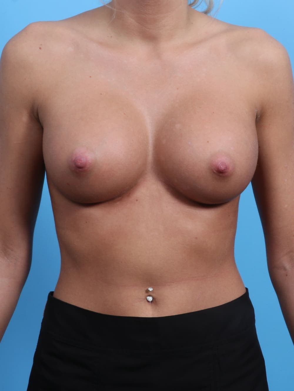 Breast Augmentation case #2947 after, image 1