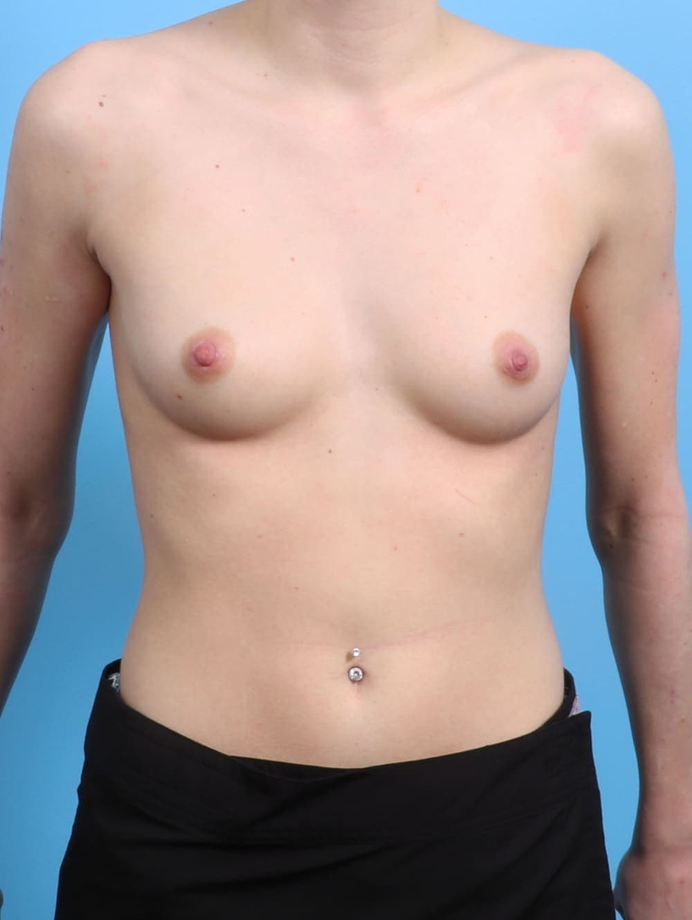 Breast Augmentation case #2947 before, image 1