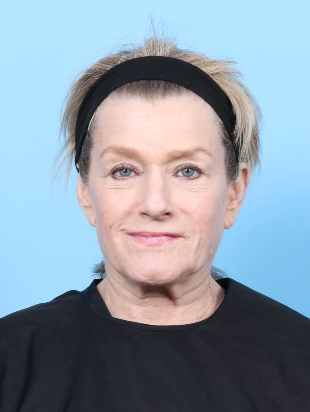 Eyelid Surgery case #6895 after