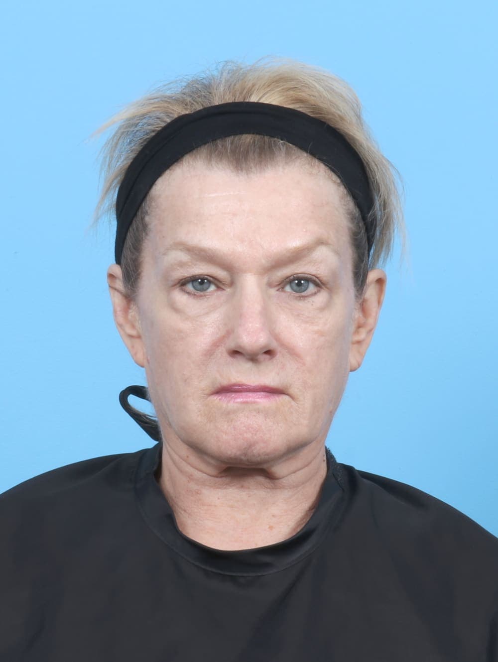 Eyelid Surgery case #6895 before