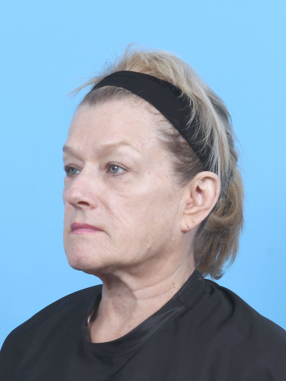 Eyelid Surgery case #6895 before, image 2