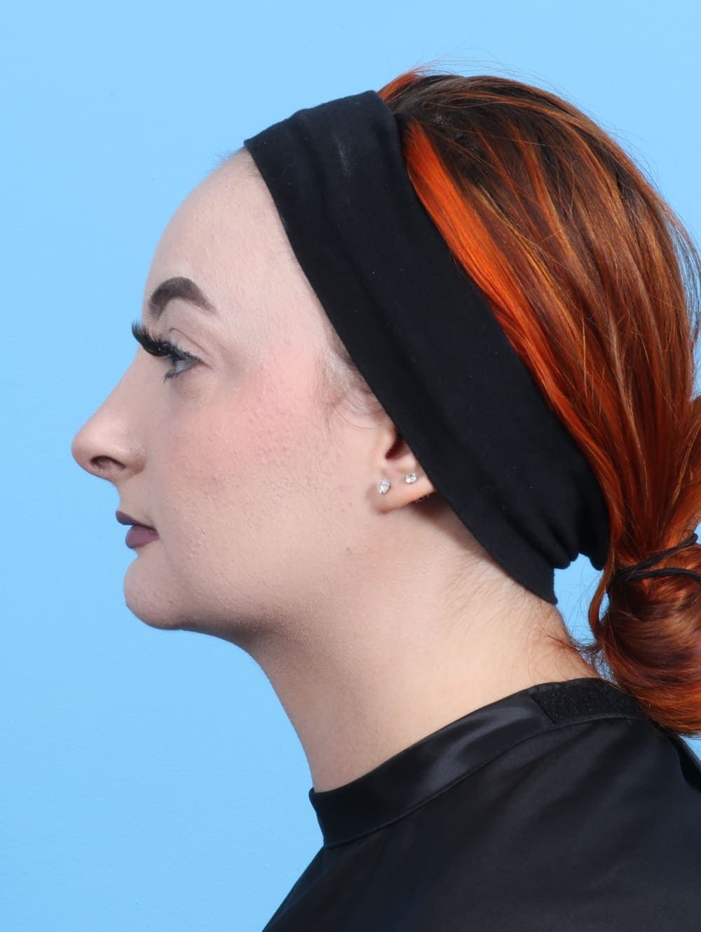 Rhinoplasty case #2528 after, image 1