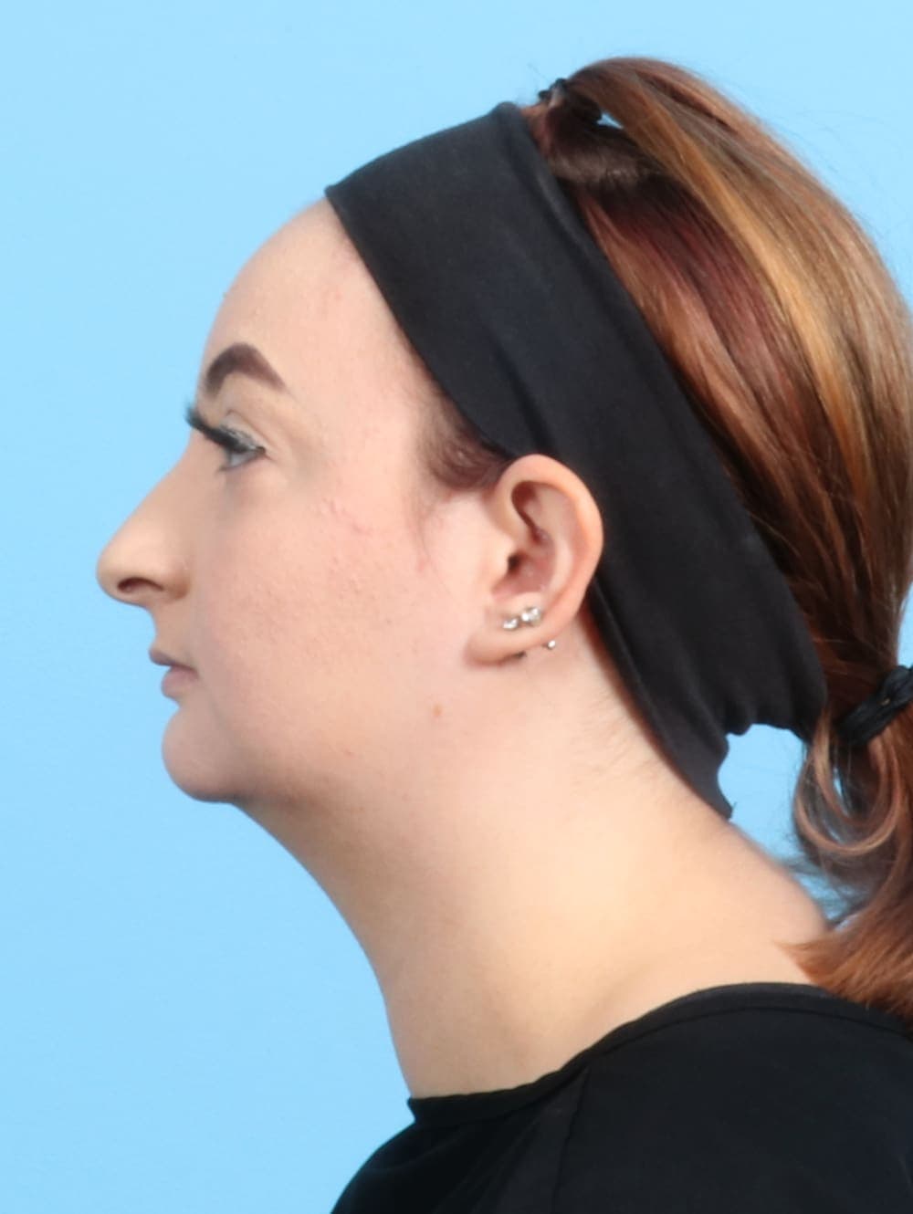Rhinoplasty case #2528 before, image 1