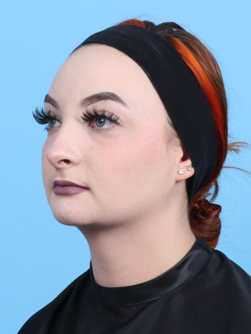 Rhinoplasty case #2528 after, image 3