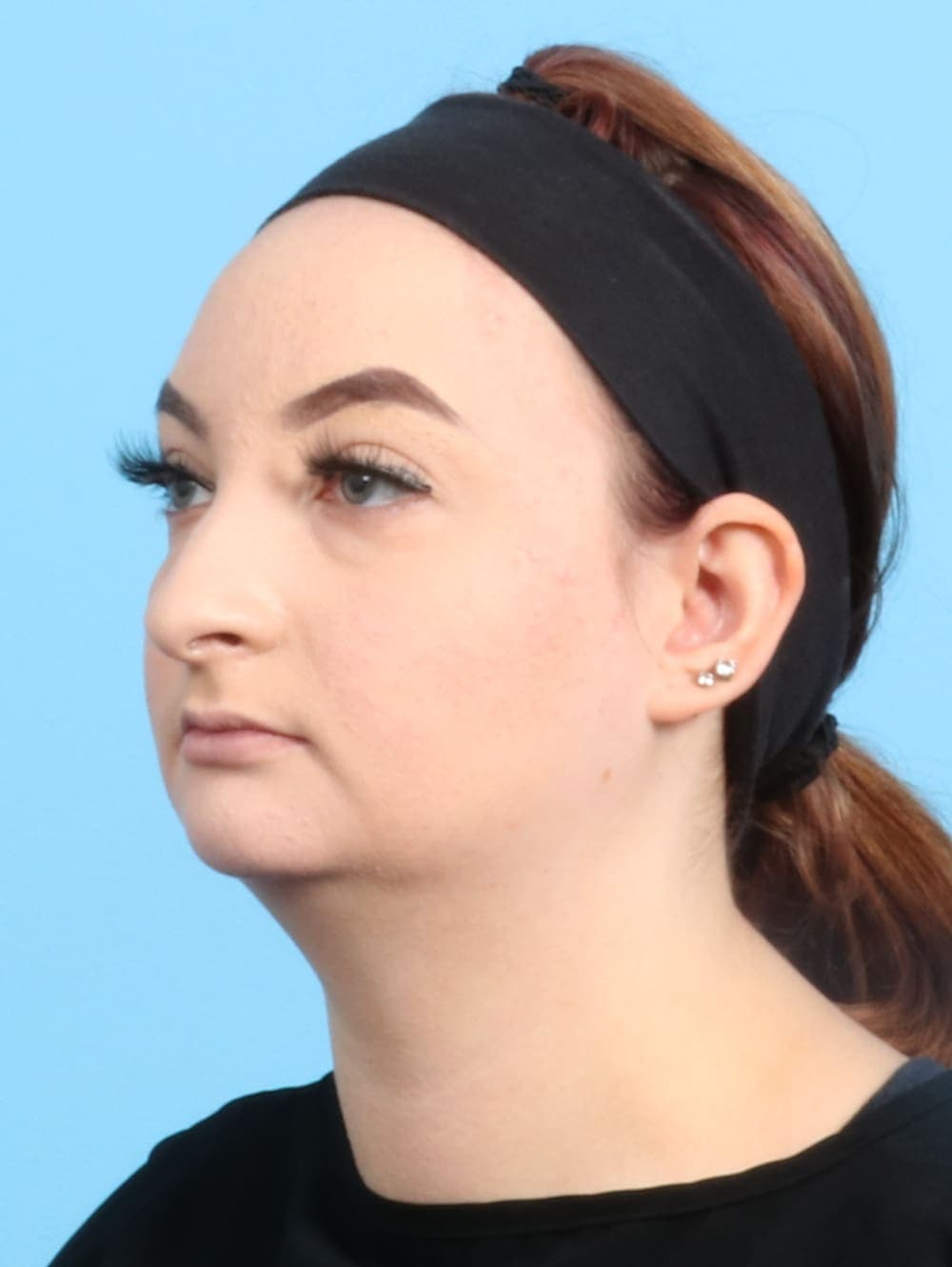 Rhinoplasty case #2528 before, image 3