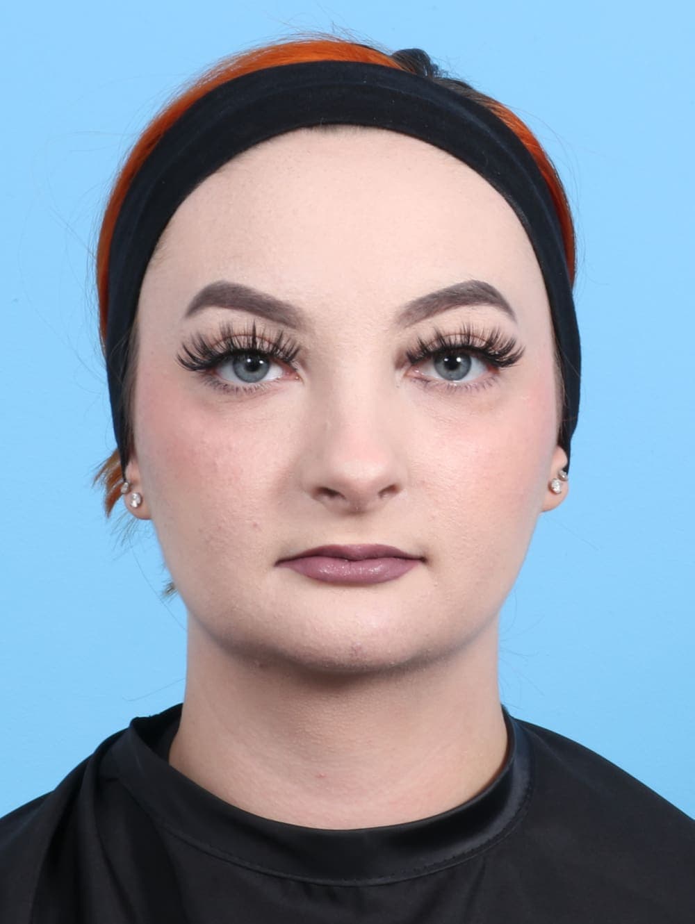 Rhinoplasty case #2528 after, image 2