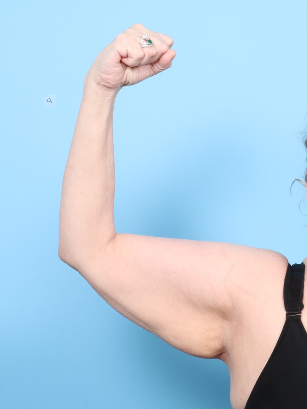 Arm Lift case #7694 before, image 2