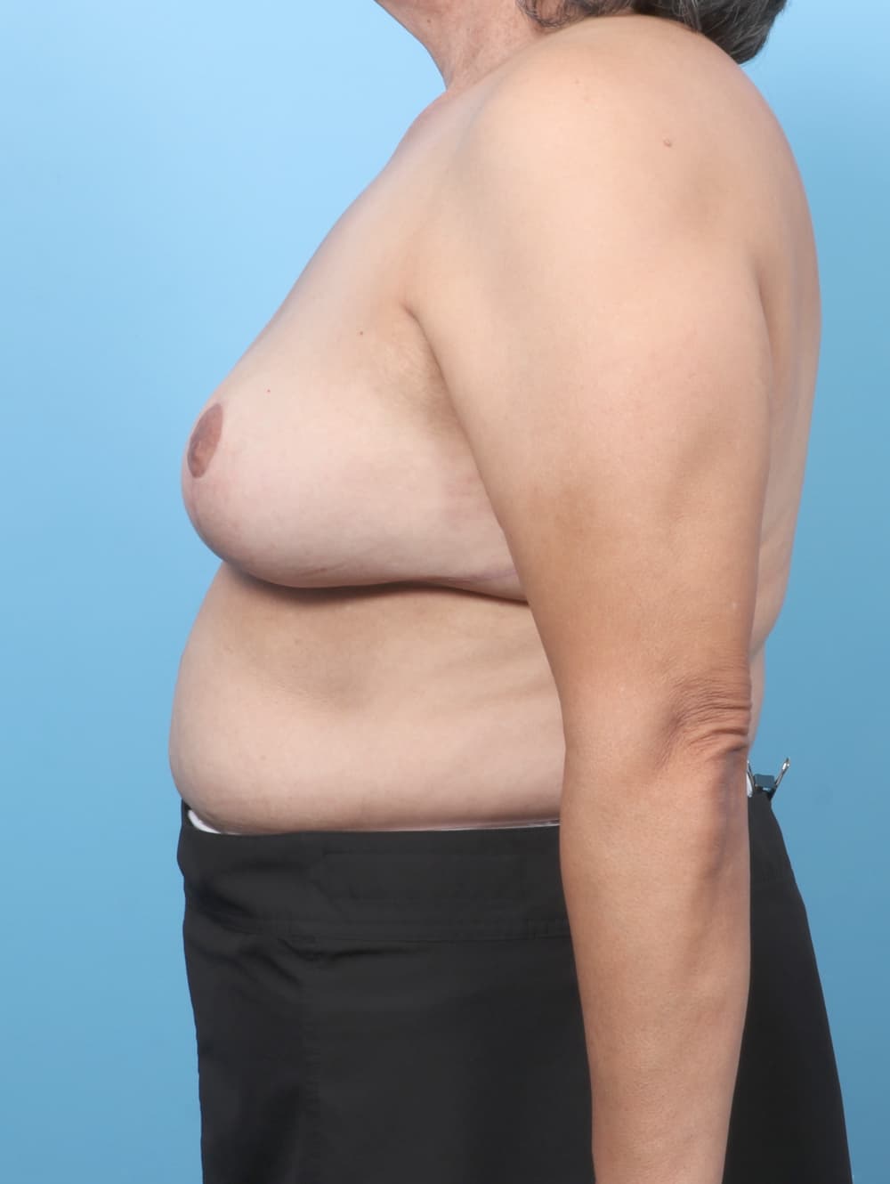 Breast Implant Revision case #8455 after, image 3