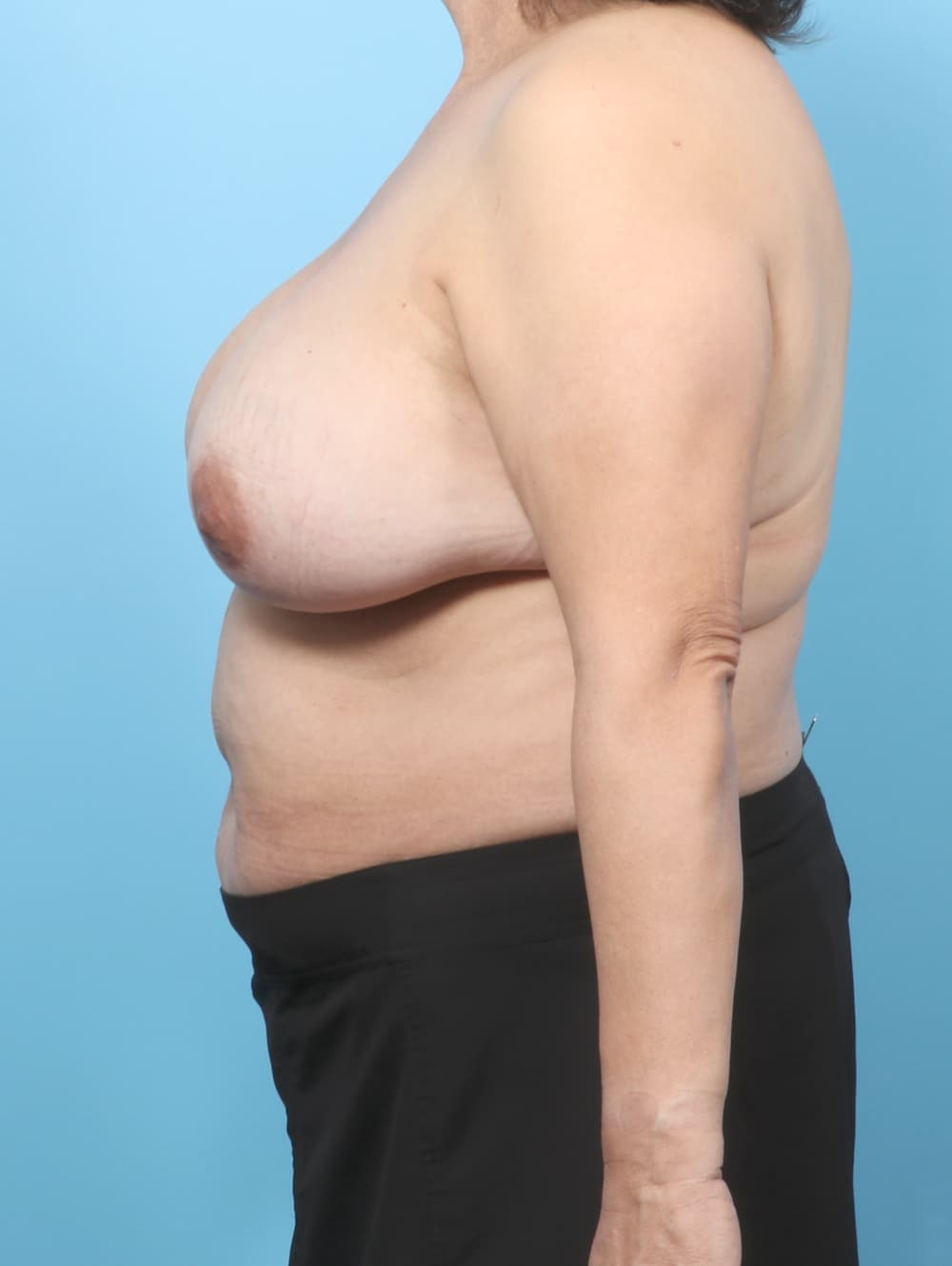 Breast Implant Revision case #8455 before, image 3