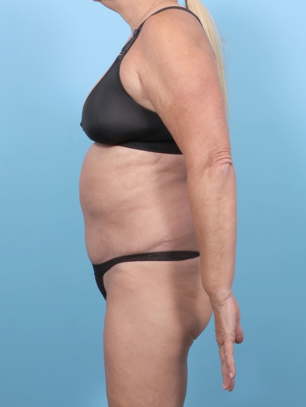 Tummy Tuck case #6301 after, image 3