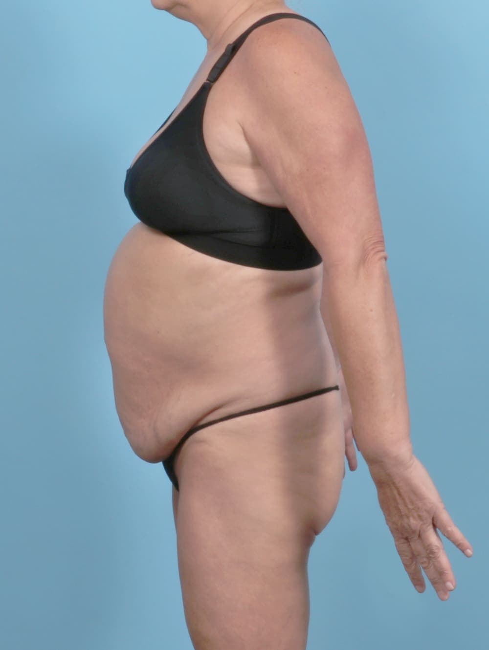 Tummy Tuck case #6301 before, image 3