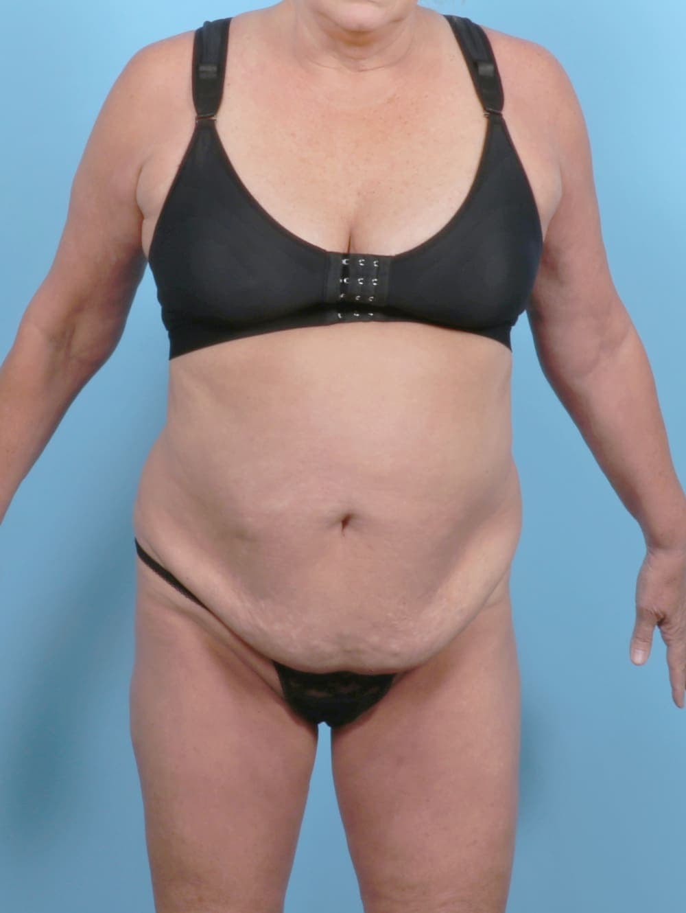 Tummy Tuck case #6301 before, image 1