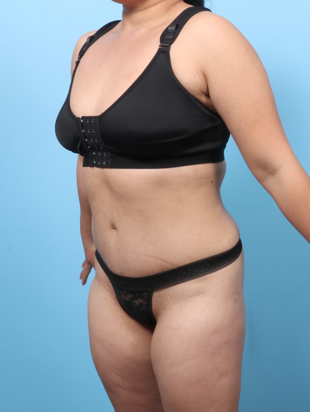 Tummy Tuck case #8912 after, image 2