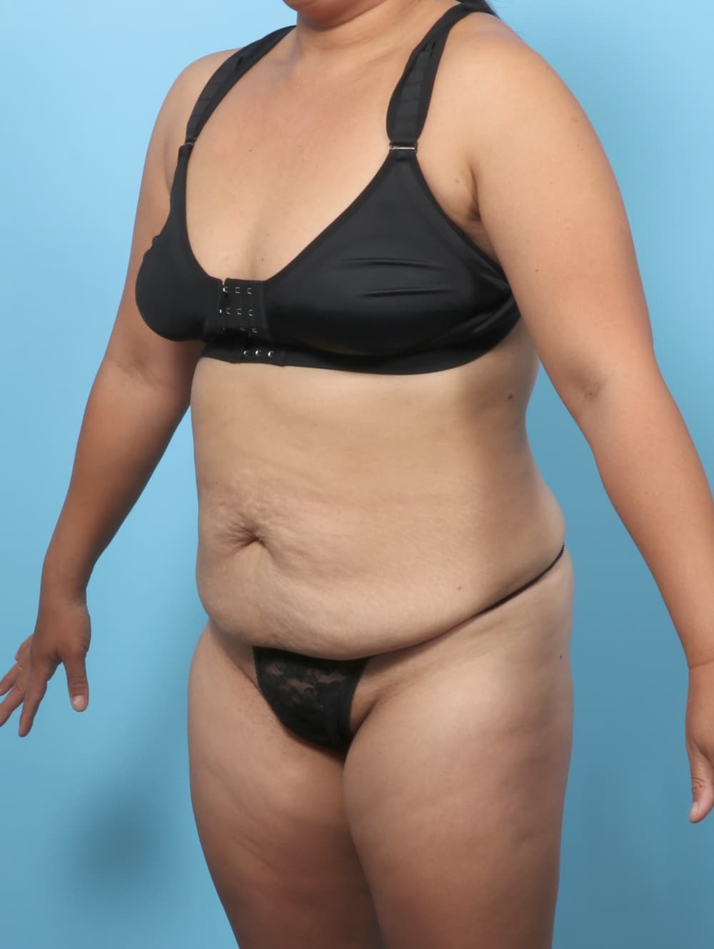 Tummy Tuck case #8912 before, image 2
