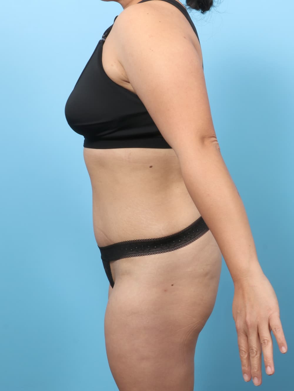 Tummy Tuck case #8912 after, image 3