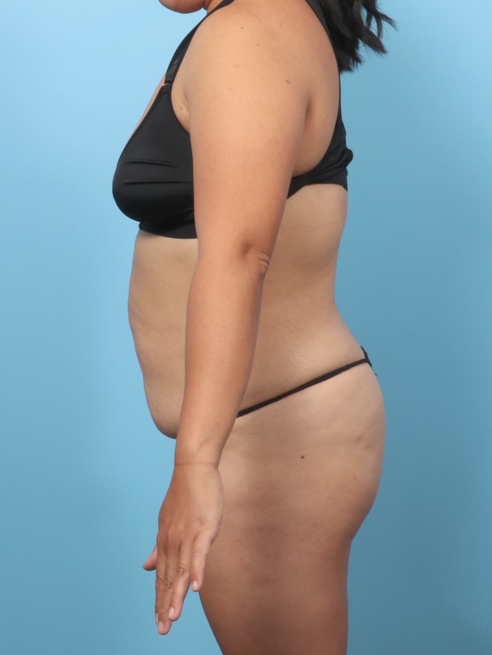 Tummy Tuck case #8912 before, image 3