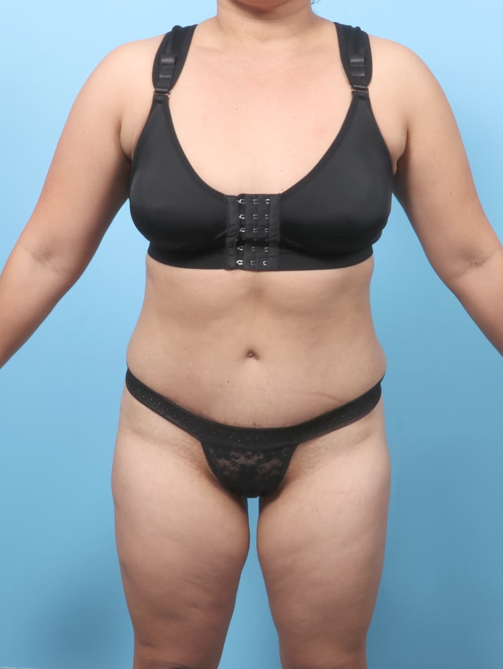 Tummy Tuck case #8912 after