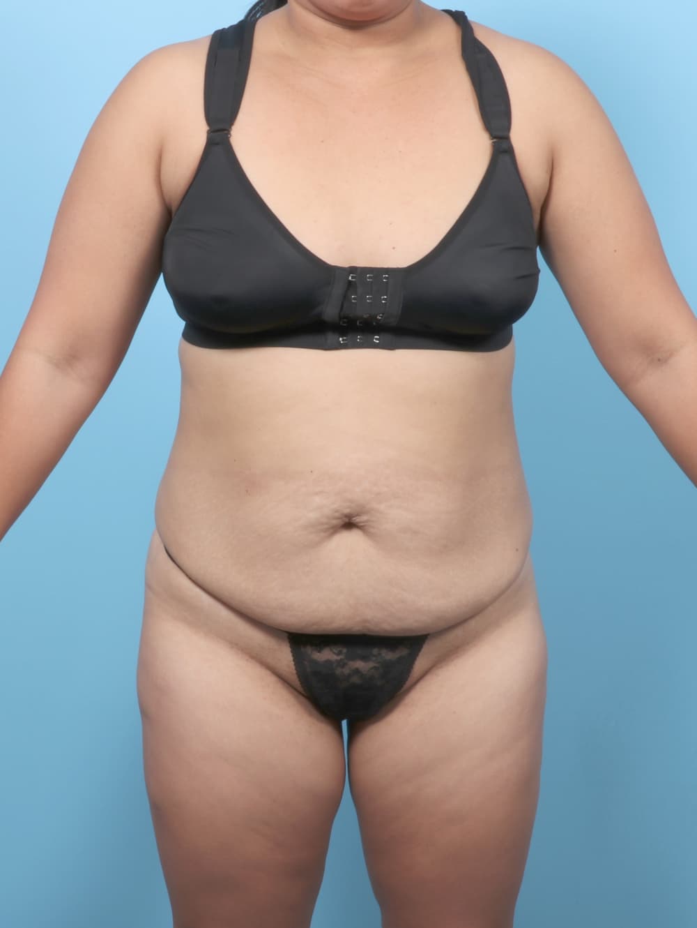 Tummy Tuck case #8912 before