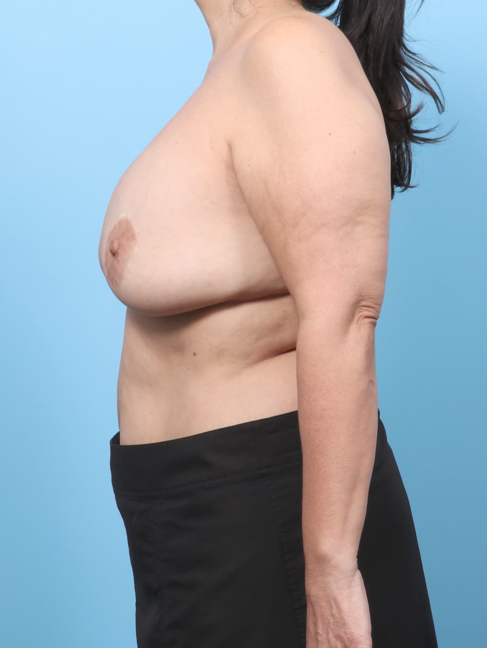 Breast Implant Removal with Lift case #8758 before, image 3