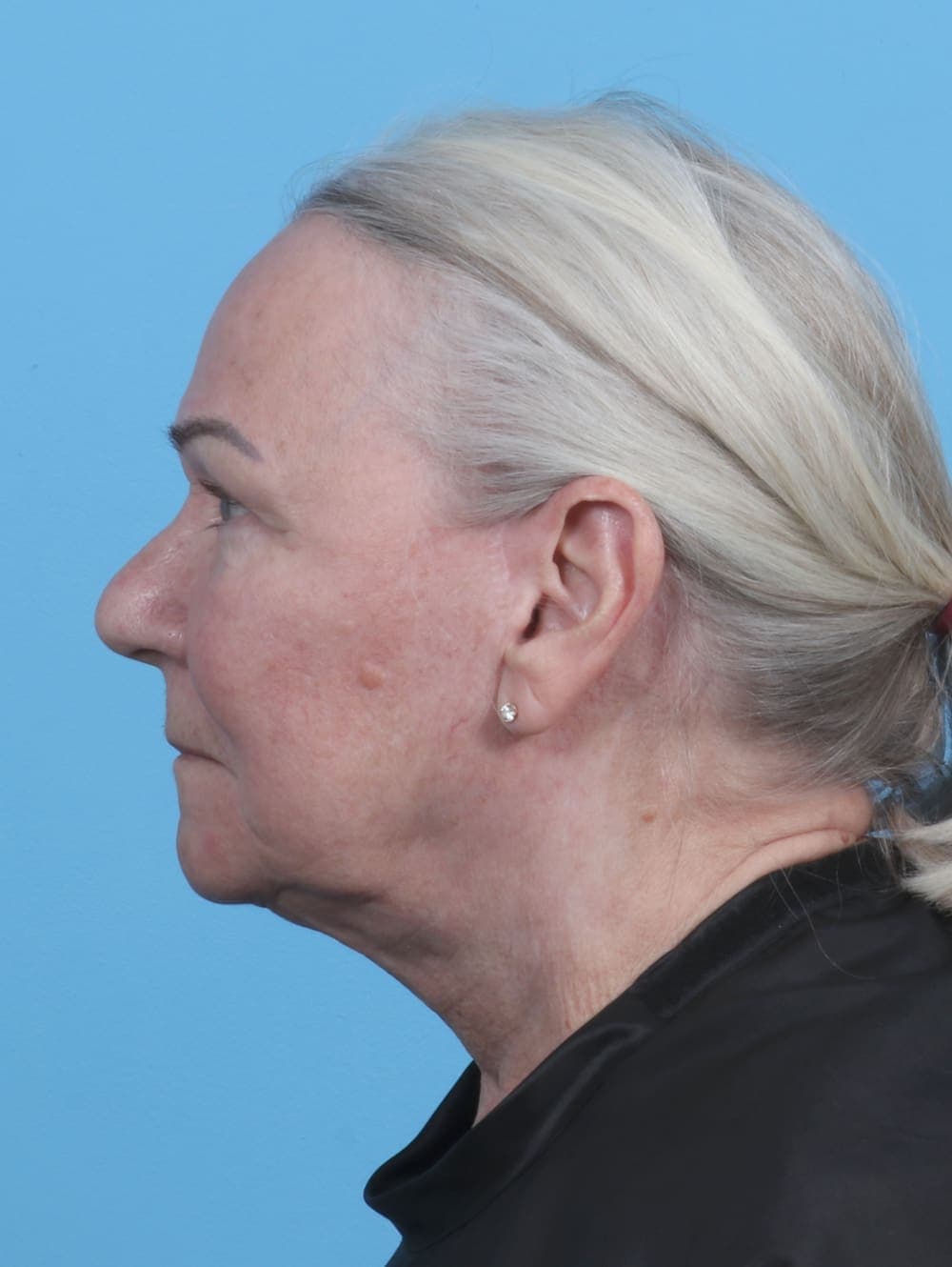 Facelift case #3667 after, image 3