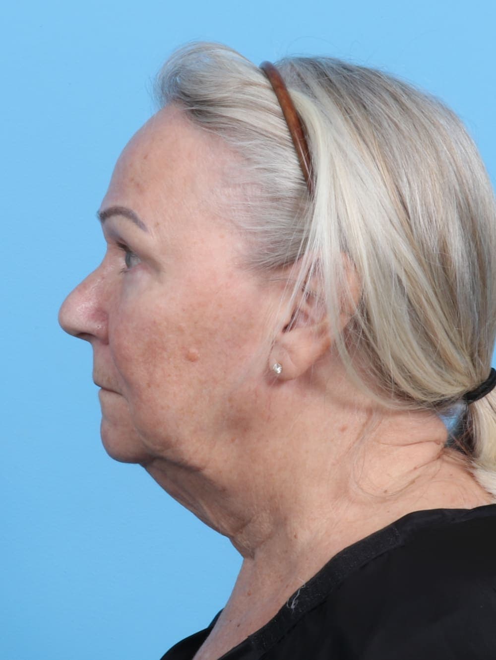 Facelift case #3667 before, image 3