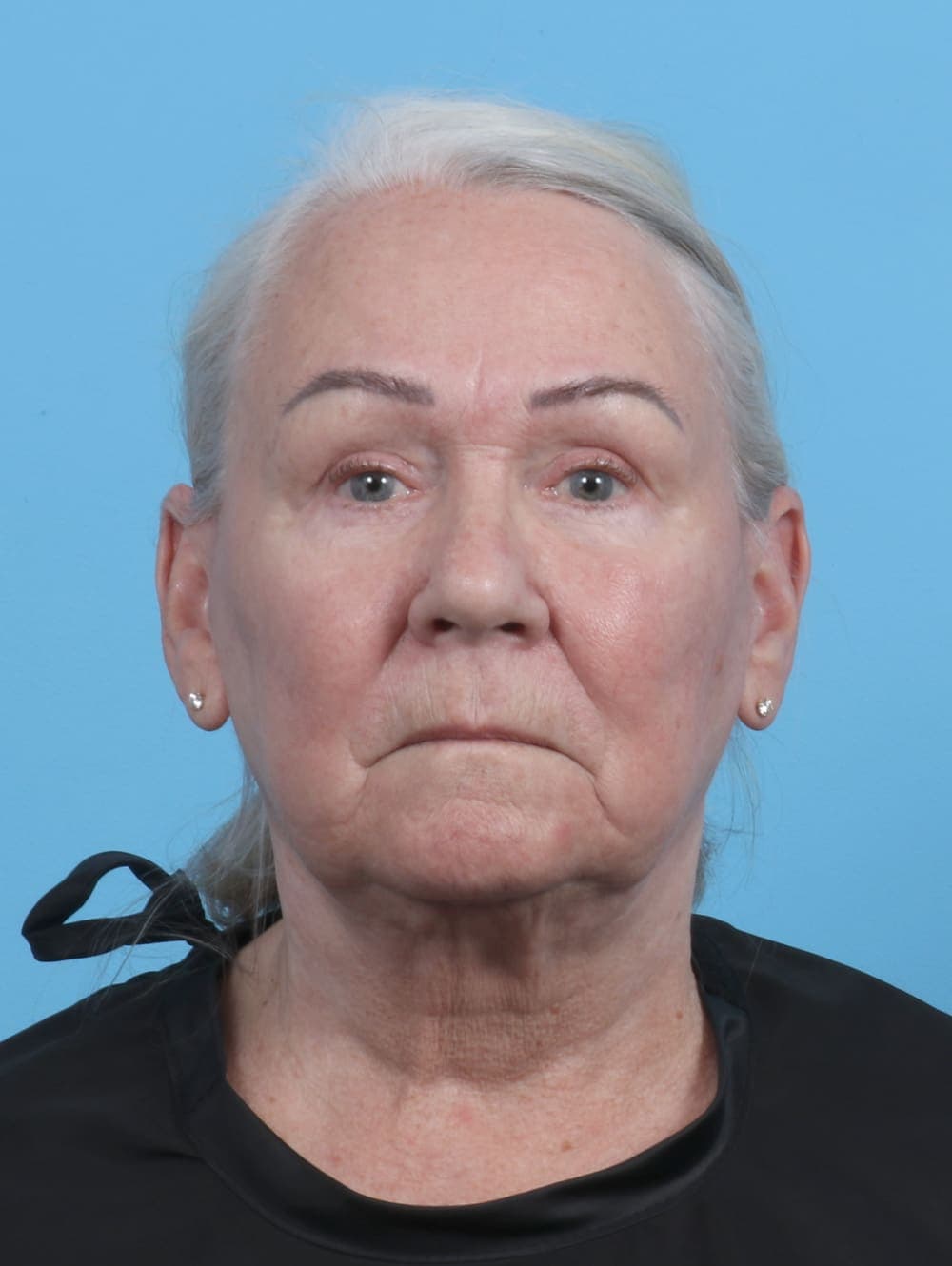 Facelift case #3667 after, image 1