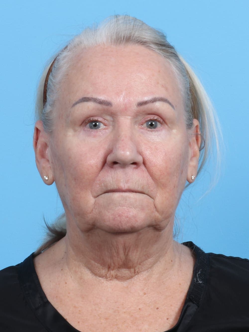 Facelift case #3667 before, image 1