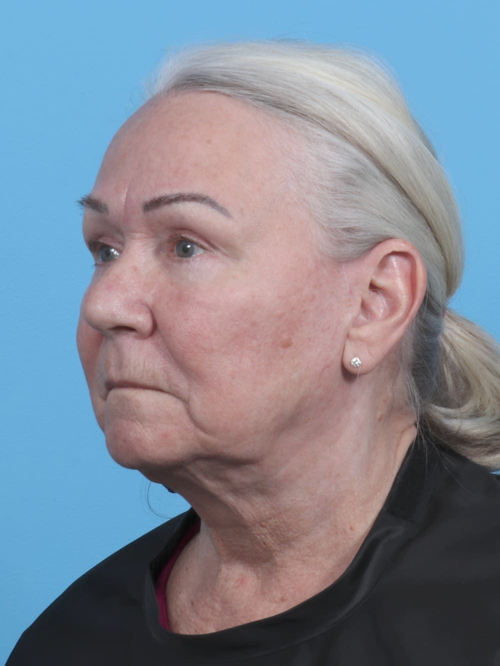 Facelift case #3667 after, image 2