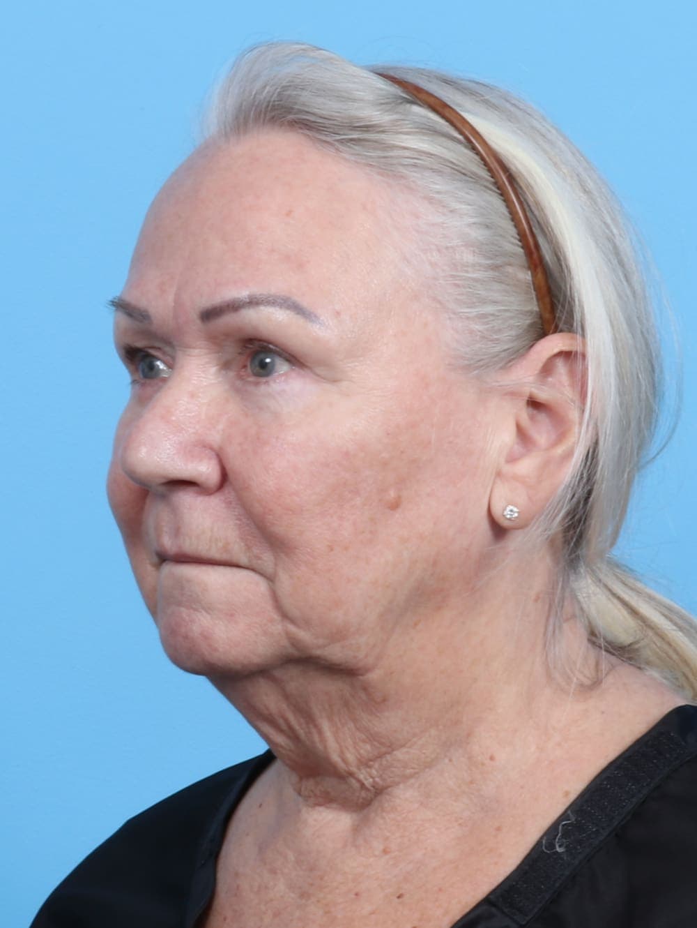 Facelift case #3667 before, image 2