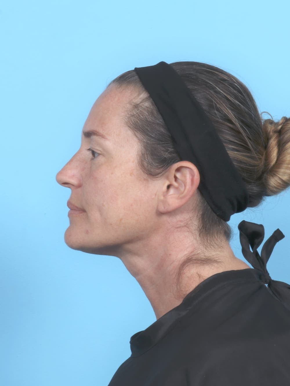 Eyelid Surgery case #6635 before, image 3