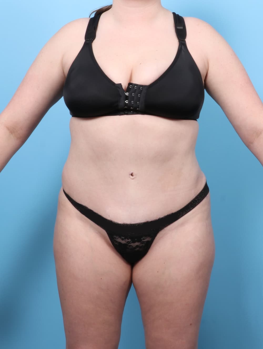 Liposuction case #7650 after, image 1