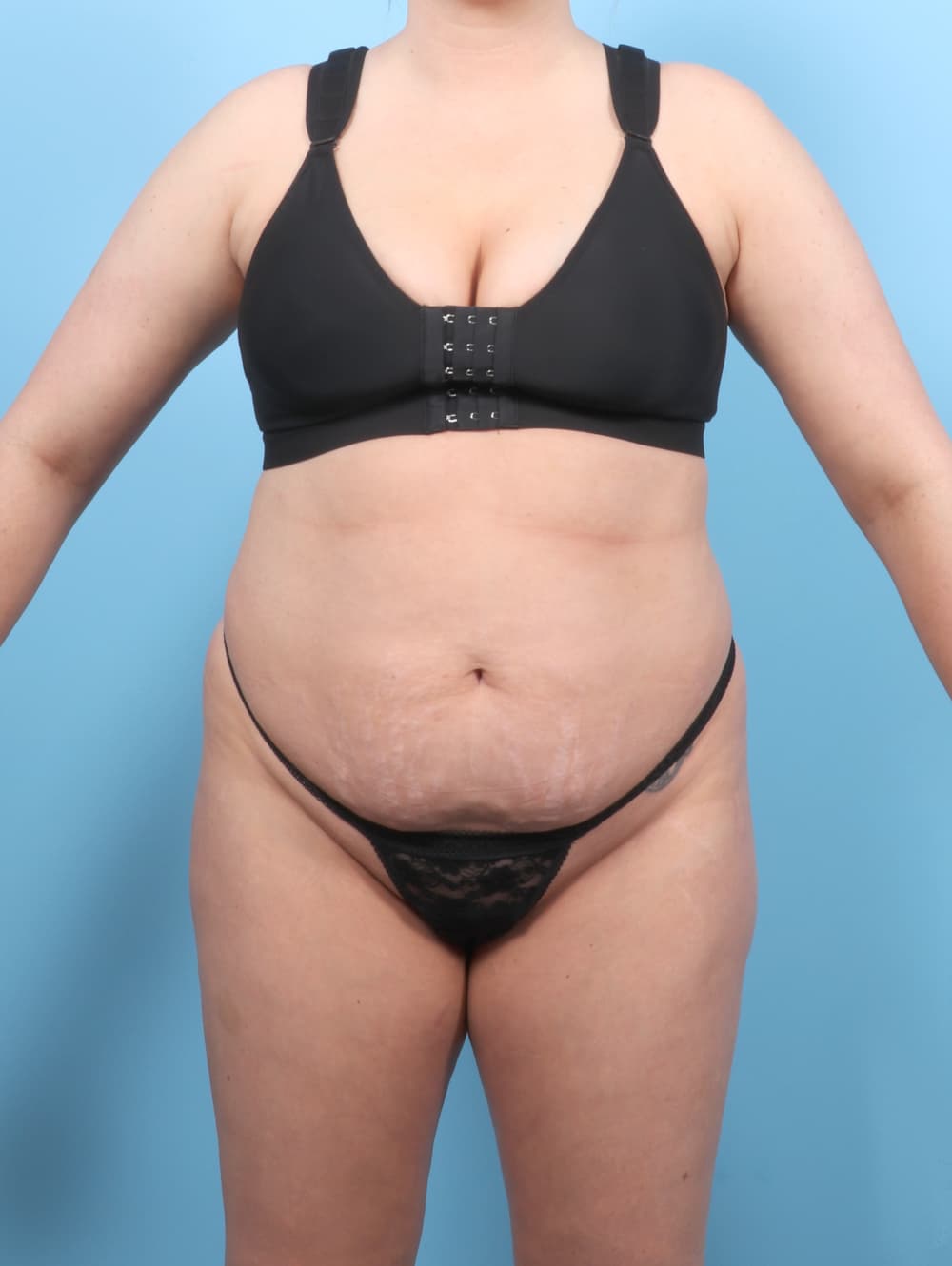 Liposuction case #7650 before, image 1
