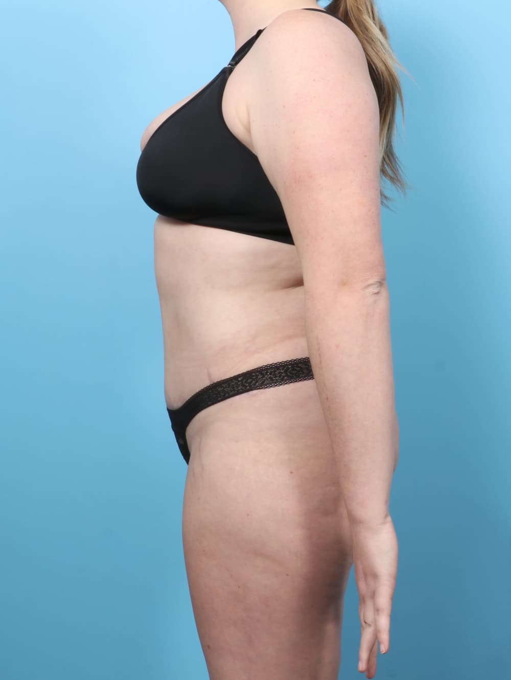 Liposuction case #7650 after, image 4