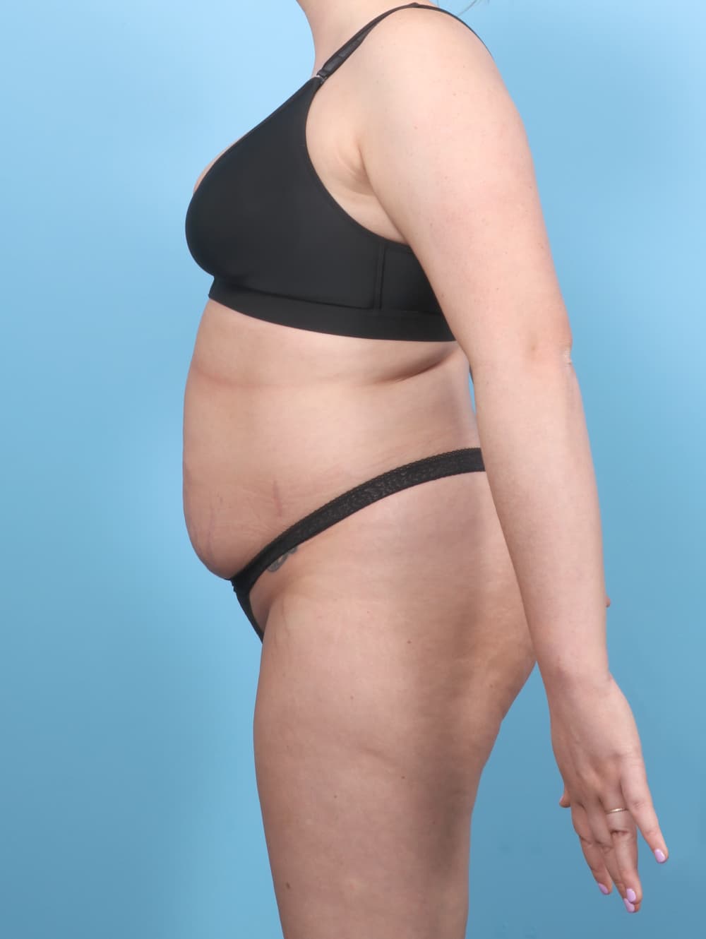 Liposuction case #7650 before, image 4