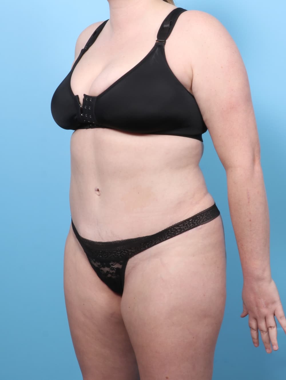 Liposuction case #7650 after, image 3
