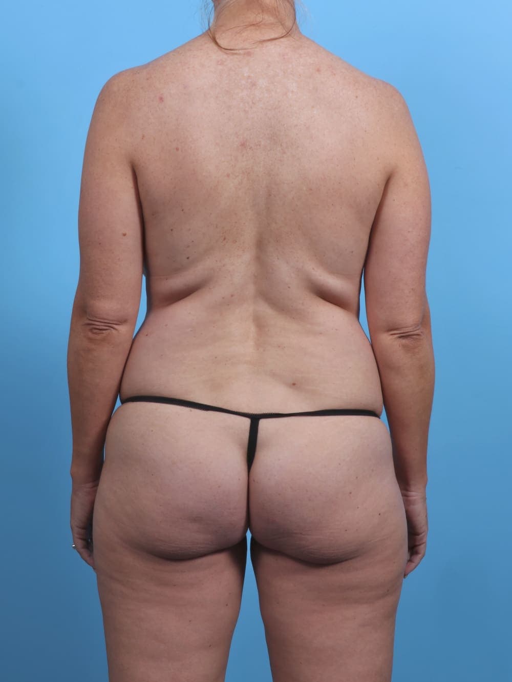 Breast Implant Revision case #4219 before, image 4