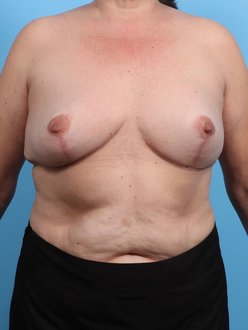 Breast Implant Removal with Lift case #3177 after, image 1