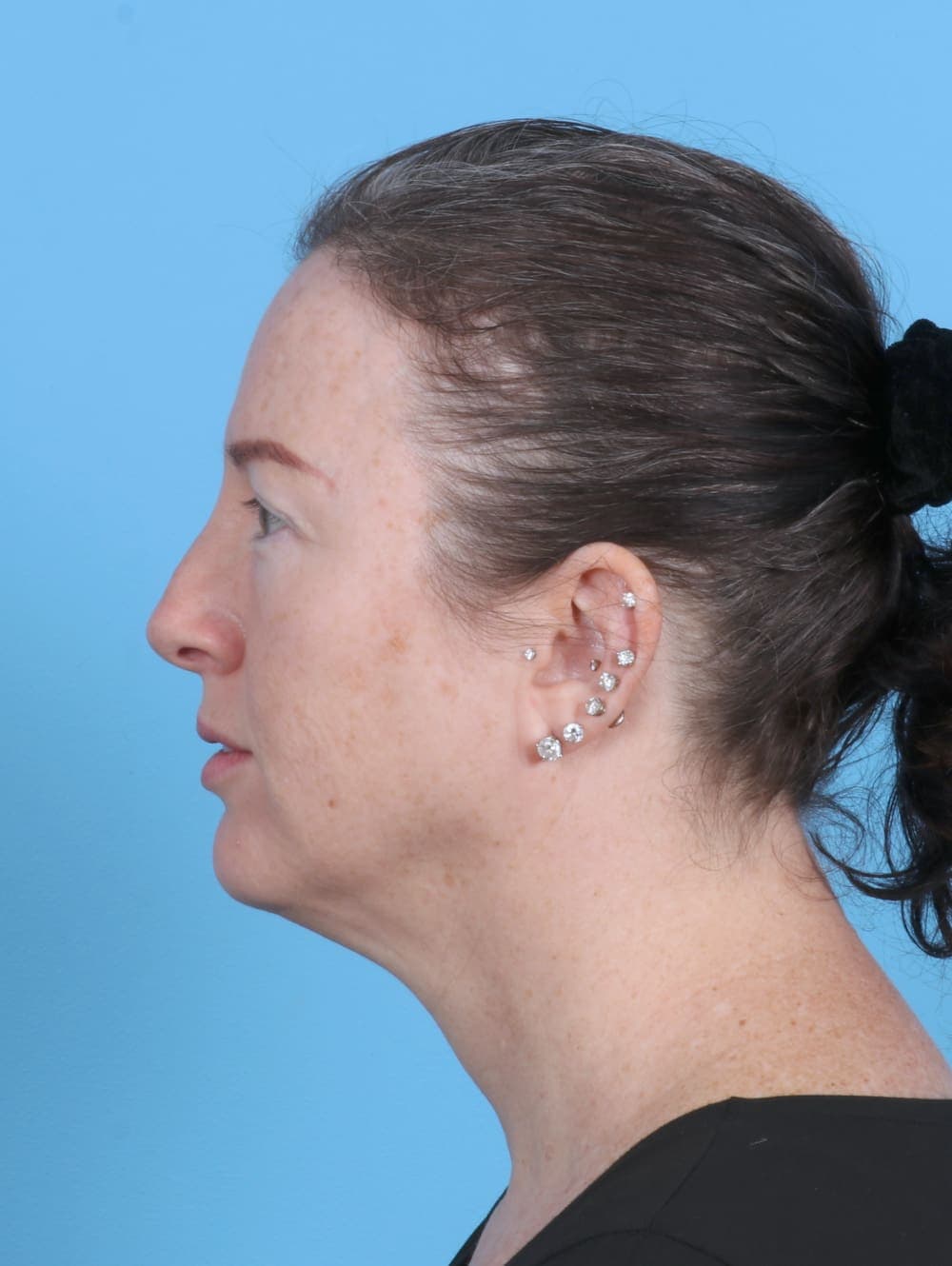 Brow Lift case #4245 after, image 3