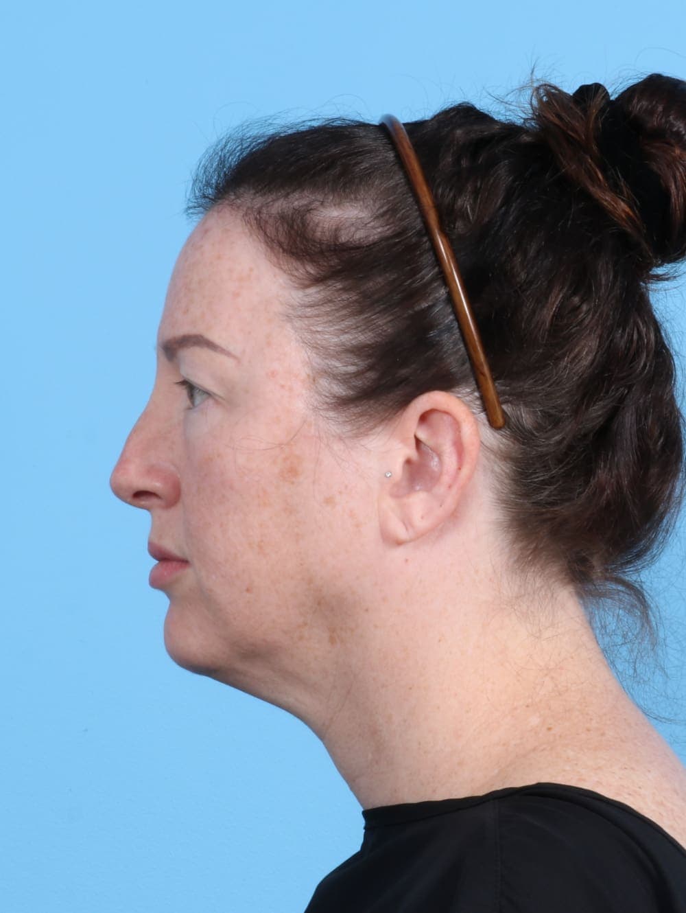 Brow Lift case #4245 before, image 3