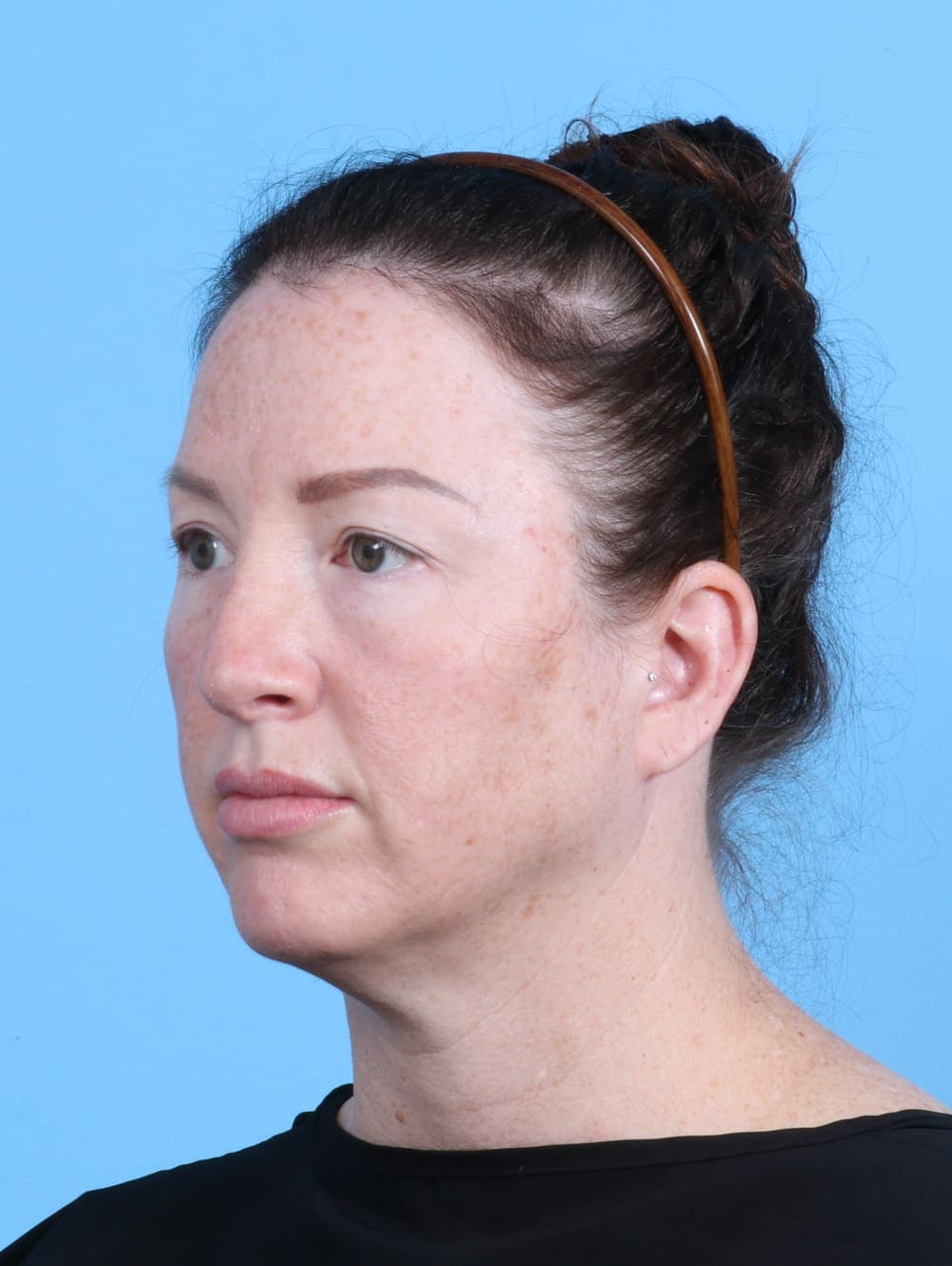 Brow Lift case #4245 before, image 2