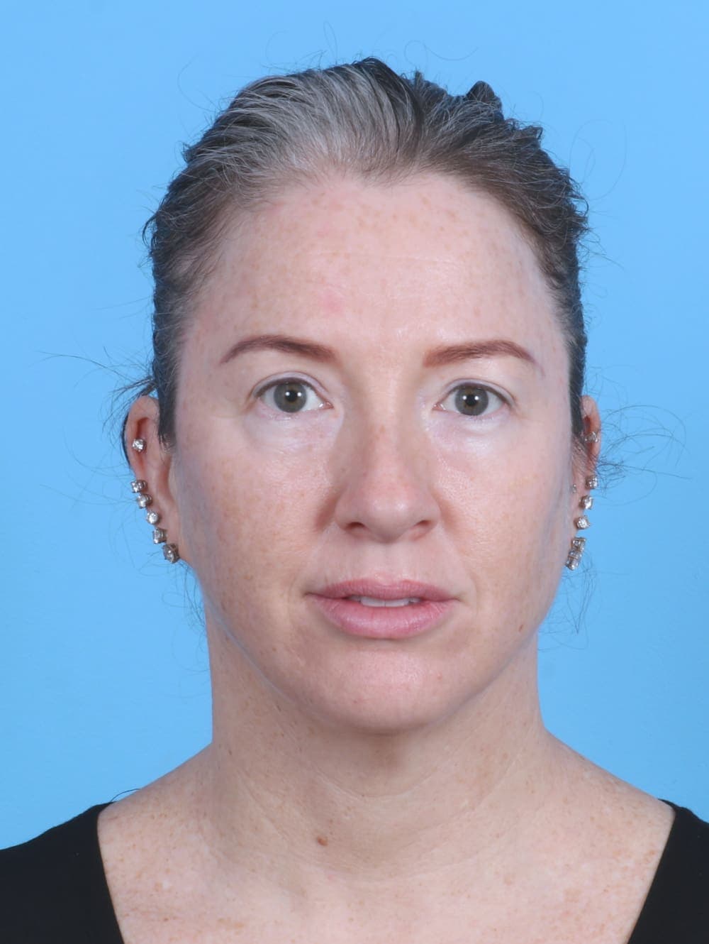 Brow Lift case #4245 after, image 1