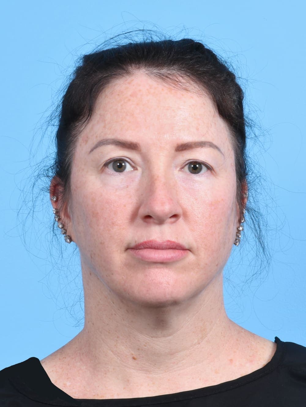 Brow Lift case #4245 before, image 1