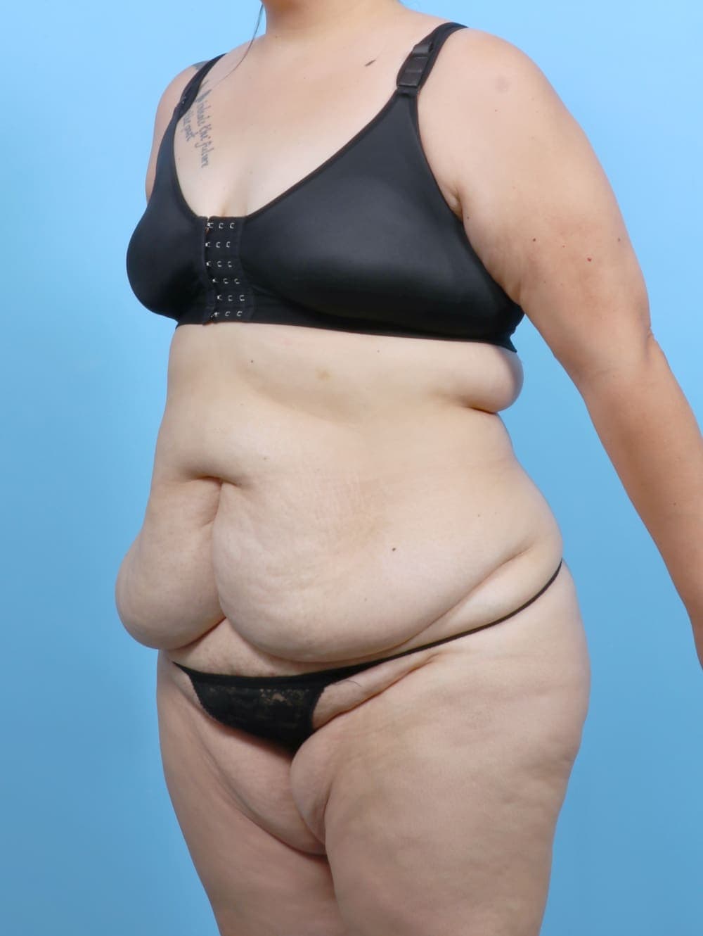 Tummy Tuck case #6383 before, image 2