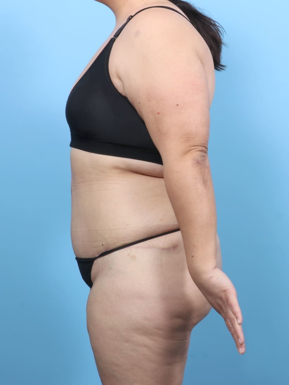 Tummy Tuck case #6383 after, image 3