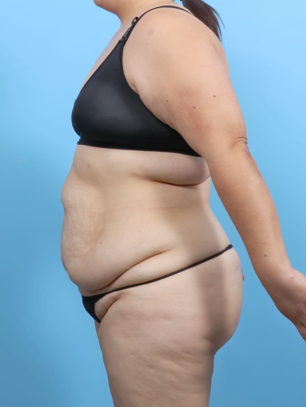 Tummy Tuck case #6383 before, image 3