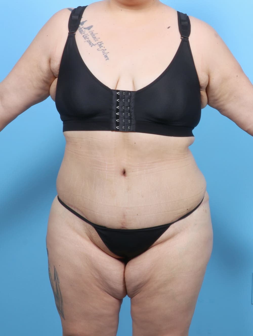 Tummy Tuck case #6383 after, image 1
